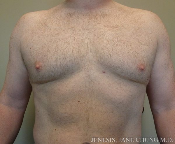 Vaser Gynecomastia Before and After Results