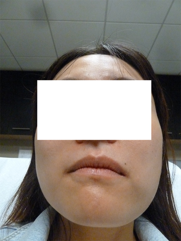 Botox Jaw Slimming Before and After Results