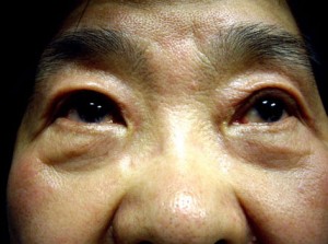 Co2 Laser Resurfacing