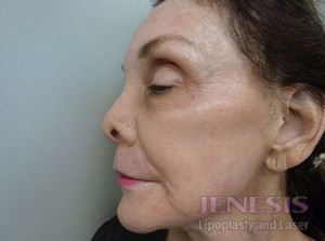 Co2 Laser Resurfacing