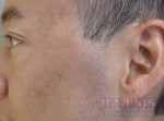 Co2 Laser Resurfacing