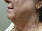 Co2 Laser Resurfacing