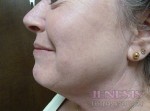 Co2 Laser Resurfacing