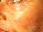 Co2 Laser Resurfacing