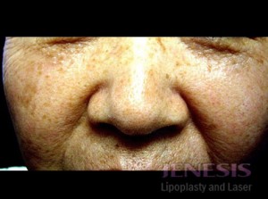 Co2 Laser Resurfacing