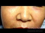 Co2 Laser Resurfacing