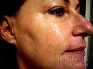 Co2 Laser Resurfacing