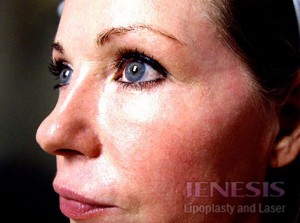 Co2 Laser Resurfacing