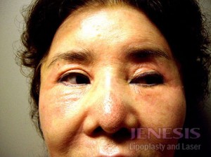 Co2 Laser Resurfacing