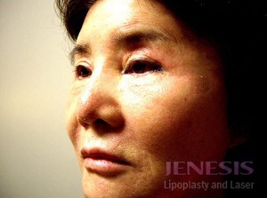 Co2 Laser Resurfacing