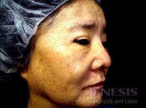 Co2 Laser Resurfacing