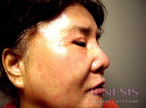 Co2 Laser Resurfacing