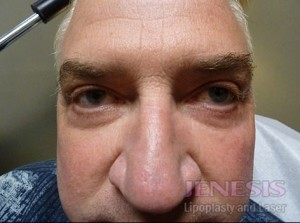Co2 Laser Resurfacing