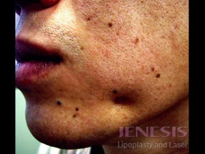 Acne Scar Treatment