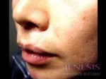 Acne Scar Treatment