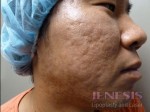 Acne Scar Treatment