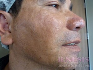 Acne Scar Treatment