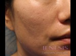 Acne Scar Treatment