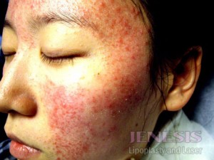 Acne Scar Treatment