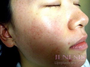 Acne Scar Treatment