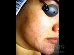 Acne Scar Treatment