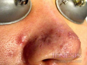 Acne Scar Treatment