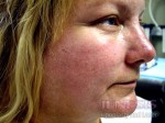 Acne Scar Treatment
