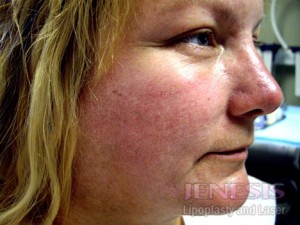 Acne Scar Treatment