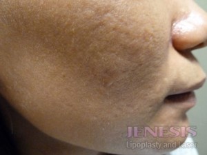 Acne Scar Treatment