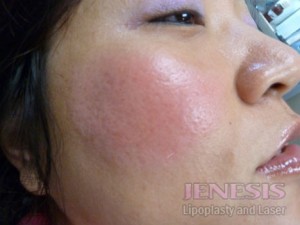 Acne Scar Treatment