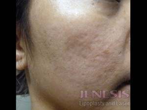 Acne Scar Treatment