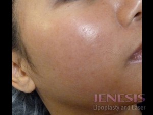 Acne Scar Treatment