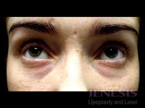 Non-surgical Dark circle removal with Filler