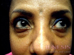 Non-surgical Dark circle removal with Filler