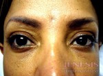 Non-surgical Dark circle removal with Filler