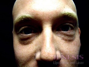 Non-surgical Dark circle removal with Filler