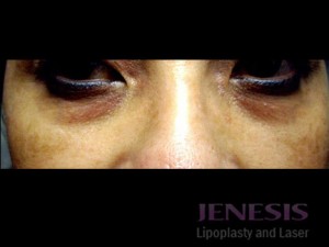 Non-surgical Dark circle removal with Filler