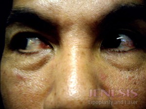 Non-surgical Dark circle removal with Filler