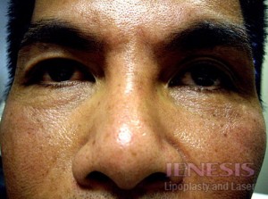 Non-surgical Dark circle removal with Filler