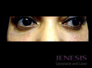 Non-surgical Dark circle removal with Filler