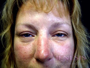 Non-surgical Dark circle removal with Filler