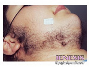 Gentlase Hair Removal