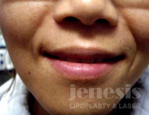 Juvederm