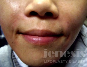 Juvederm