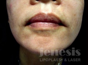 Juvederm