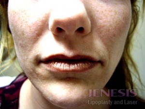 Juvederm