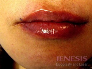 Juvederm