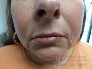 Juvederm