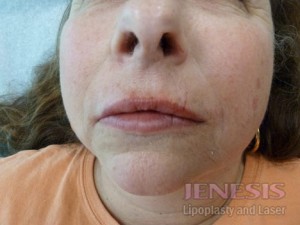 Juvederm