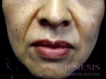 Juvederm